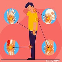 Bild zum Thema Rheuma